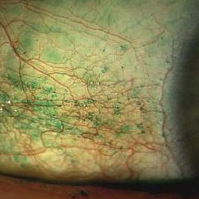 Read more about the article A clear-eyed view of preservatives in tears