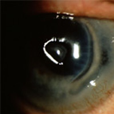 Read more about the article Performing LASIK on autoimmune patients may not be as risky as once thought