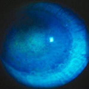 Read more about the article A reprieve for dry eye patients