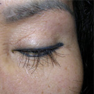 Read more about the article Eyelash transplant surgery poses serious risks