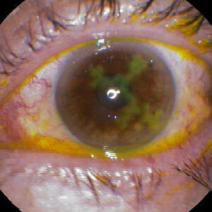 Read more about the article Treating HSV keratitis