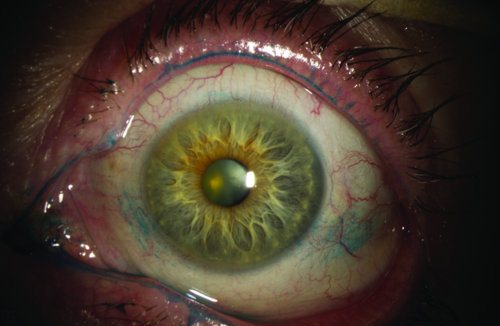 Practitioners can use lissamine green to stage dry eye  Source: James P. McCulley, M.D.