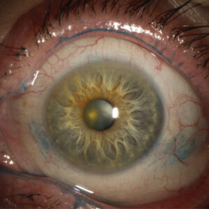 Read more about the article Dry eye patterns with lissamine green