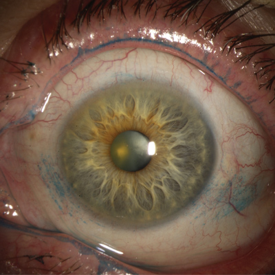 Read more about the article Dry eye patterns with lissamine green