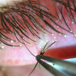 Read more about the article Demodex treatment options
