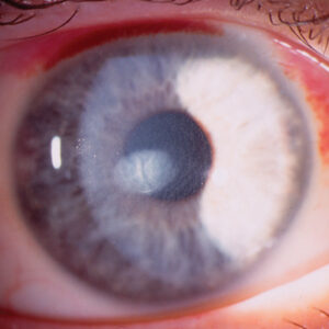 Read more about the article A worrisome complication of LASIK