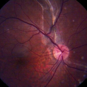 Read more about the article Successful retinal detachment surgery?
