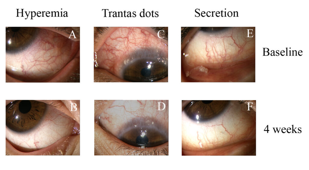 The top images show characteristics at baseline during a slitlamp examination of vernal keratoconjunctivitis patients; as seen in the bottom images, investigators saw an improvement in conjunctival hyperemia, Trantas dots, and secretion after four weeks of Lactobacilli eye-drop treatment  Source: Alfonso Iovieno, M.D.