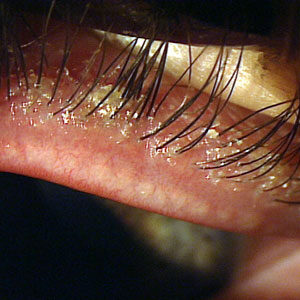 Read more about the article New antibiotic option for the treatment of blepharitis