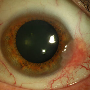Read more about the article Symptoms, treatment for eye lesions