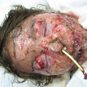 Read more about the article Newer treatments offer hope for Stevens-Johnson Syndrome