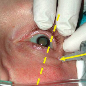 Read more about the article Double trouble: Diplopia following cataract or refractive surgery