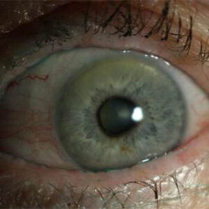 Read more about the article Non-pharmaceutical therapies for dry eye