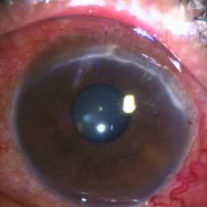 Read more about the article Mooren’s ulcer vs. PUK: The difference can mean life or death