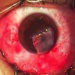 Read more about the article Pterygium excision