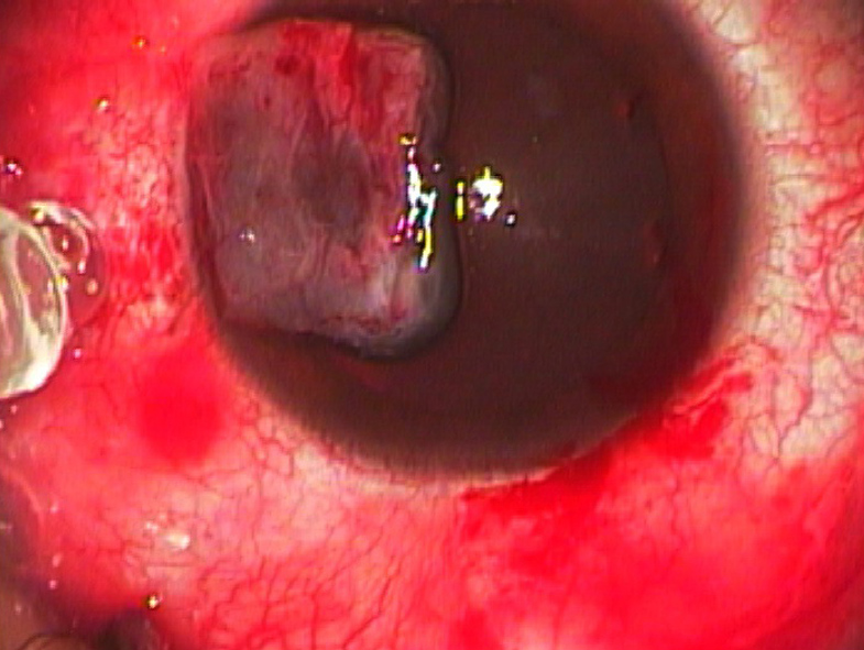 Figures 10 and 11. Thrombin (black label vial) diluted with balanced salt solution is placed on the excision site, and fibrinogen (blue label vial) is placed on the stromal side of the autograft