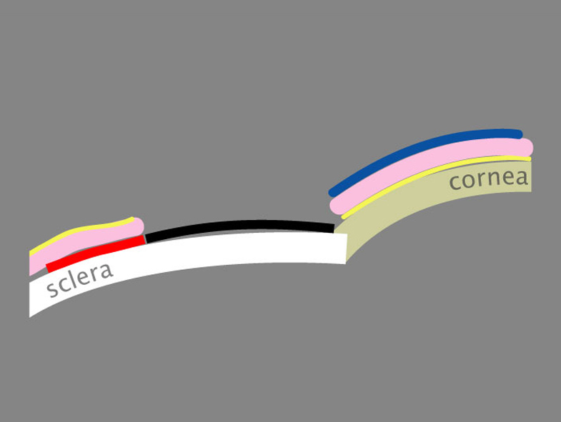 Figures 10 and 11. Thrombin (black label vial) diluted with balanced salt solution is placed on the excision site, and fibrinogen (blue label vial) is placed on the stromal side of the autograft