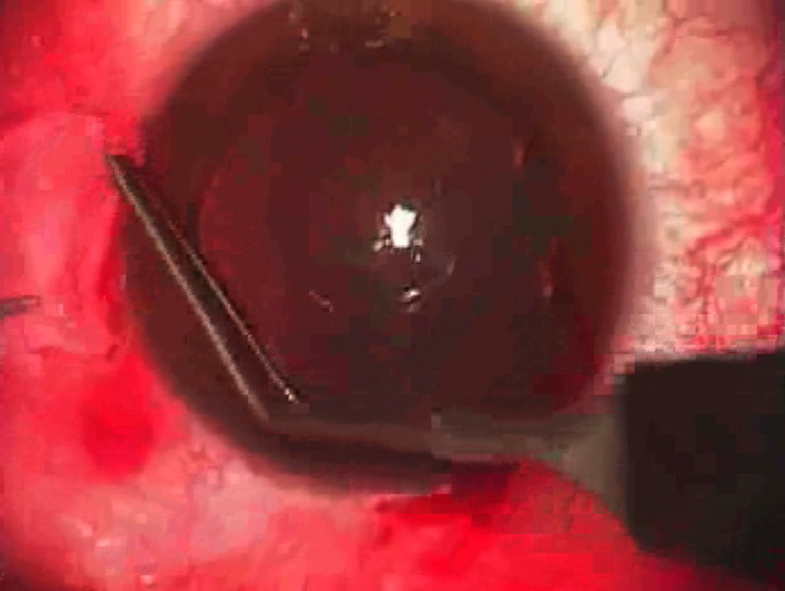 Figures 12 and 13. The conjunctival autograft is inverted, mixing the adhesive components, and smoothed to approximate the edges of conjunctiva Source (all):โJohn A. Hovanesian, M.D.