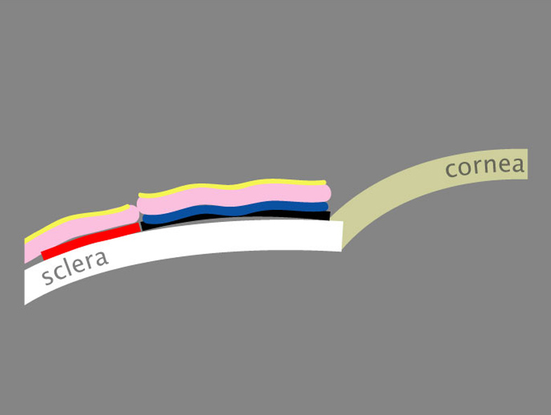 Figures 12 and 13. The conjunctival autograft is inverted, mixing the adhesive components, and smoothed to approximate the edges of conjunctiva Source (all):โJohn A. Hovanesian, M.D.