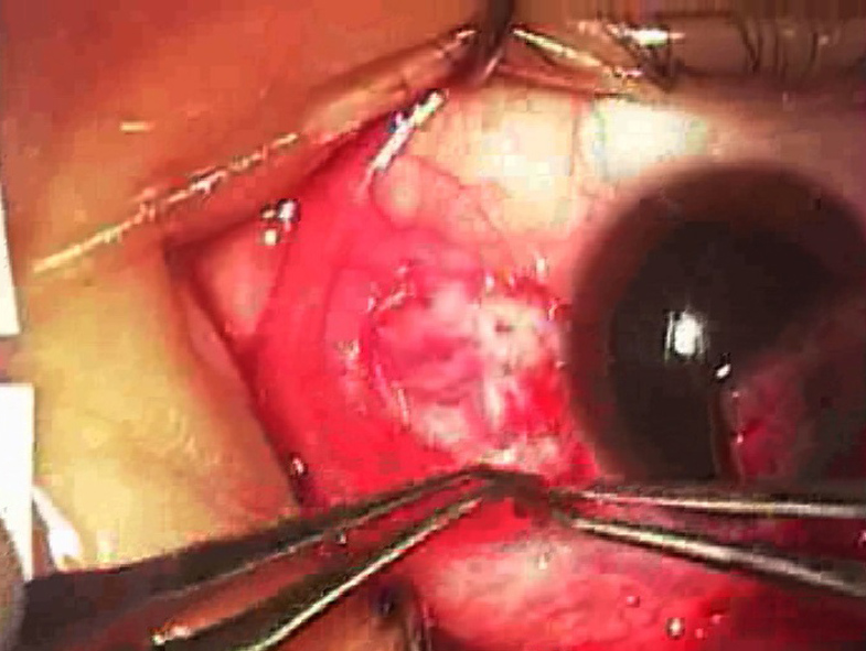 Figures 5 and 6. The graft is tucked into the subconjunctival space to provide its antifibrotic effects to Tenon's fascia, from which pterygium recurrence might arise