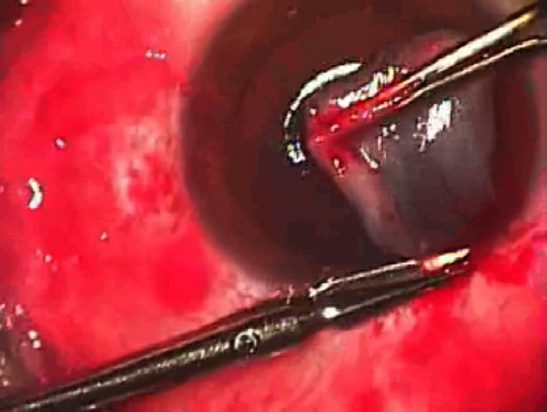 Figure 8. From the superior limbus, the conjunctival autograft is cut free from the superior limbus