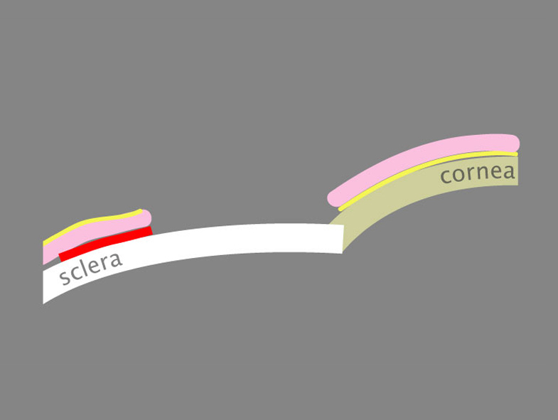 Figure 9. The free conjunctival autograft is inverted on the cornea (note the yellow epithelial surface of graft shown against the corneal epithelium) and oriented limbus-to-limbus adjacent to the excision site