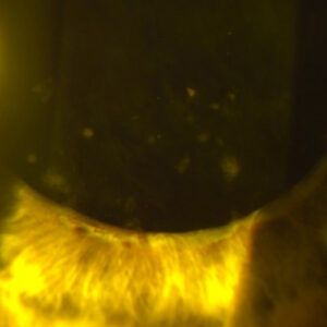 Read more about the article Uveitis: Posterior synechiae, lens deposits, CME, prolonged post-op inflammation, and secondary glaucoma