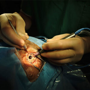 Read more about the article Post-surgical ptosis: Causes and treatments