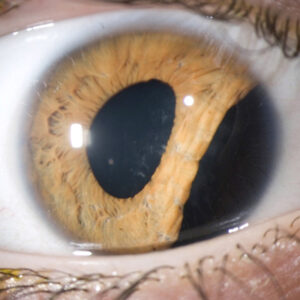 Read more about the article Cataract surgery in the setting of iris defects