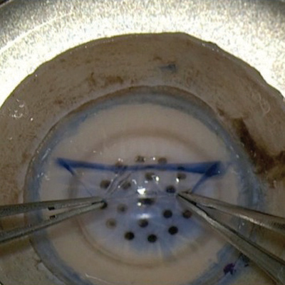 Read more about the article Cornea surgeons compare thin DSAEK and DMEK as options for endothelial keratoplasty procedures