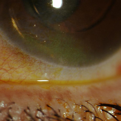Read more about the article Managing dry eye in glaucoma, retinal patients