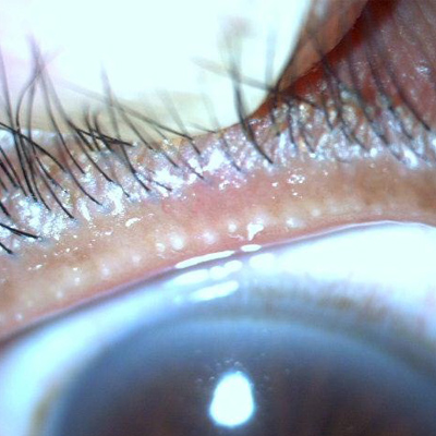 Read more about the article Surgeons step cautiously toward dry eye supplements