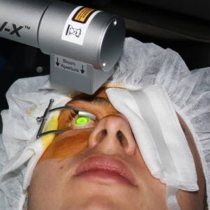 Read more about the article Post-operative management of corneal crosslinking patients