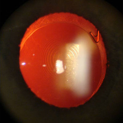 Read more about the article Understanding positive dysphotopsia