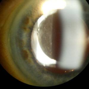 Read more about the article Treating, eliminating negative dysphotopsia