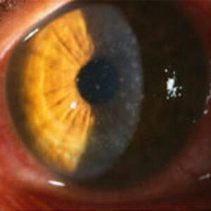 Read more about the article Adenoviral conjunctivitis: Identifying and treating