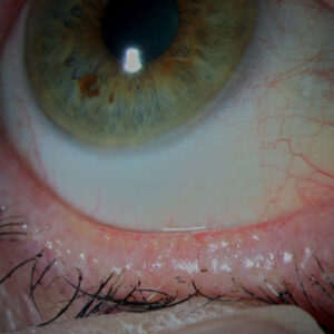 Read more about the article How effective is lid warming for meibomian gland dysfunction?