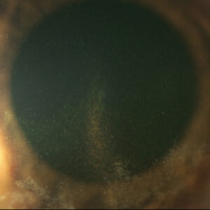 Read more about the article Pearls for care in pigmentary glaucoma