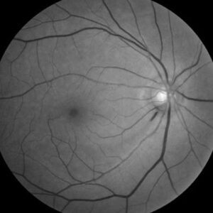 Read more about the article Normal tension glaucoma: Who gets it and who goes blind?