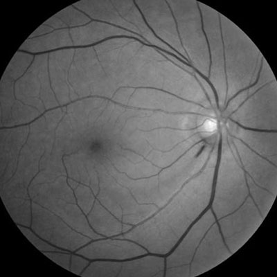 Read more about the article Normal tension glaucoma: Who gets it and who goes blind?