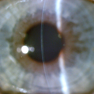 Slit lamp image taken 1 day after SMILE. It is hardly visible that the cornea underwent lenticule removal the day before. Source: Jesper Hjortdal, MD