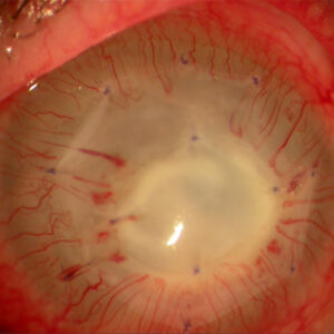 Read more about the article To use or not to use amniotic membrane