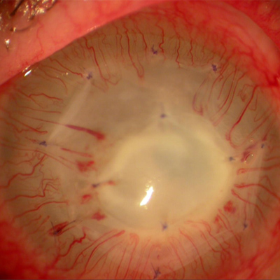 Read more about the article To use or not to use amniotic membrane
