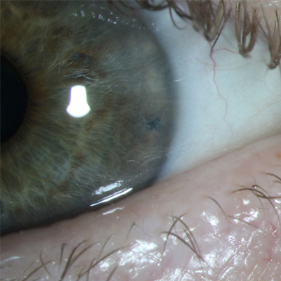 Read more about the article Iridotomy is done: Now what?