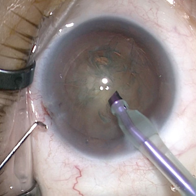 Read more about the article Cataract surgery in long eyes