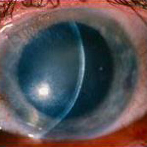 Read more about the article Tips for steroid use in HSV