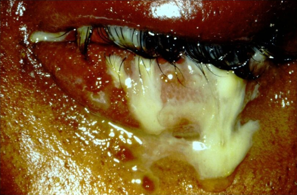 Dramatic acute purulent discharge in a patient with Neisseria gonorrhoeae conjunctivitis Source: Vincent de Luise, MD