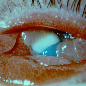 Read more about the article Diagnosis and treatment of hyperacute bacterial conjunctivitis