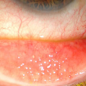 Read more about the article Understanding chronic conjunctivitis