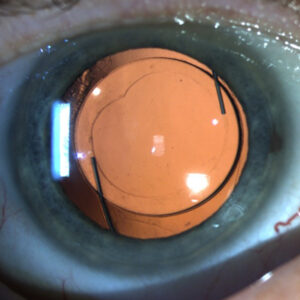 Read more about the article What to know about the Light Adjustable Lens